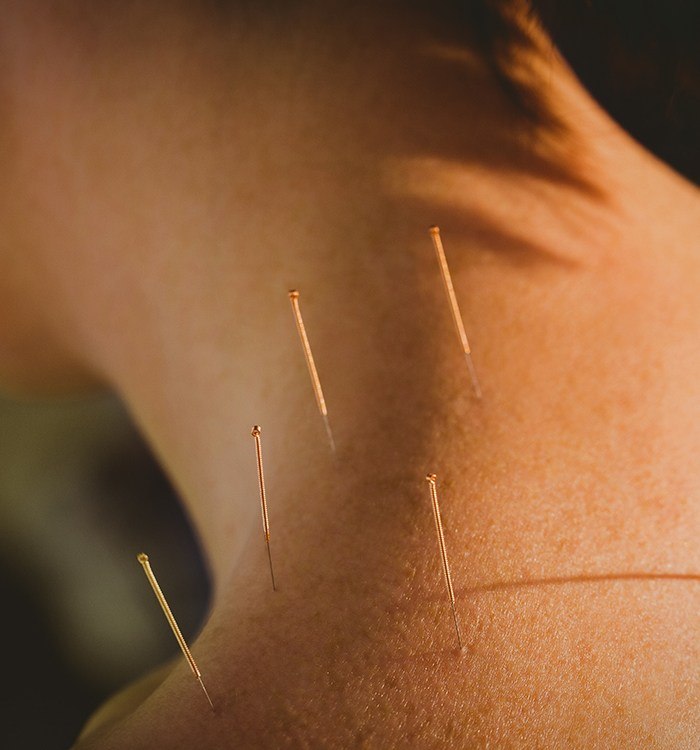 Patient receiving medical acupuncture on neck