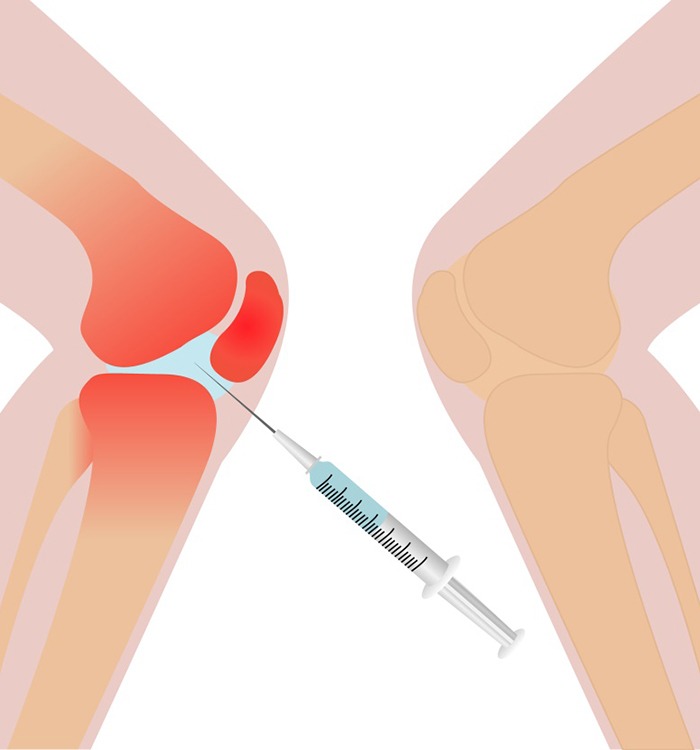 Illustration showing orthopedic injection in knee