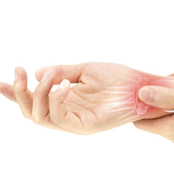person with Carpal Tunnel Syndrome bracing wrist