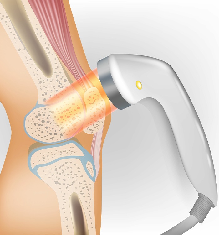Illustration of laser therapy on knee arthritis