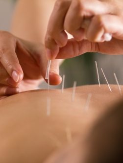 Physician performing medical acupuncture on patient's back