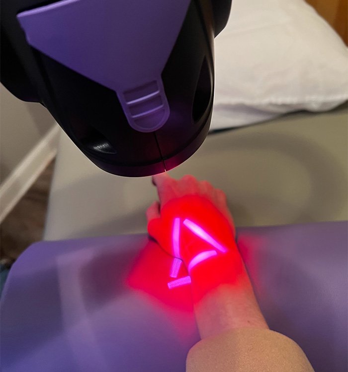 MLS Robotic Laser Therapy treating patient with carpal tunnel syndrome