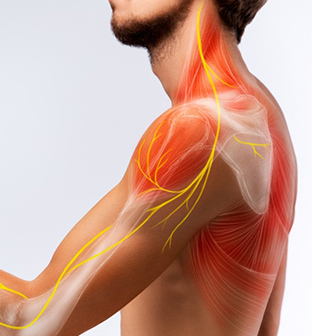 Man with overlay of animated nerves and muscles after nerve hydrodissection