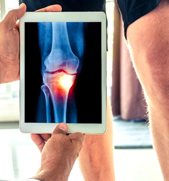 doctor evaluating a man’s knee for osteoarthritis 
