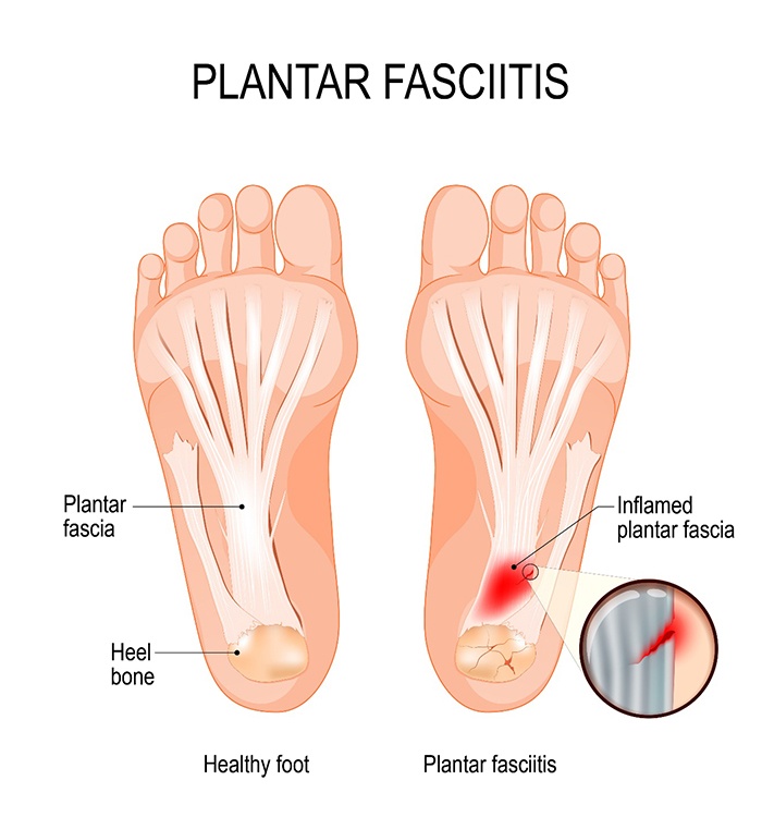 diagram showing foot with plantar fasciitis 