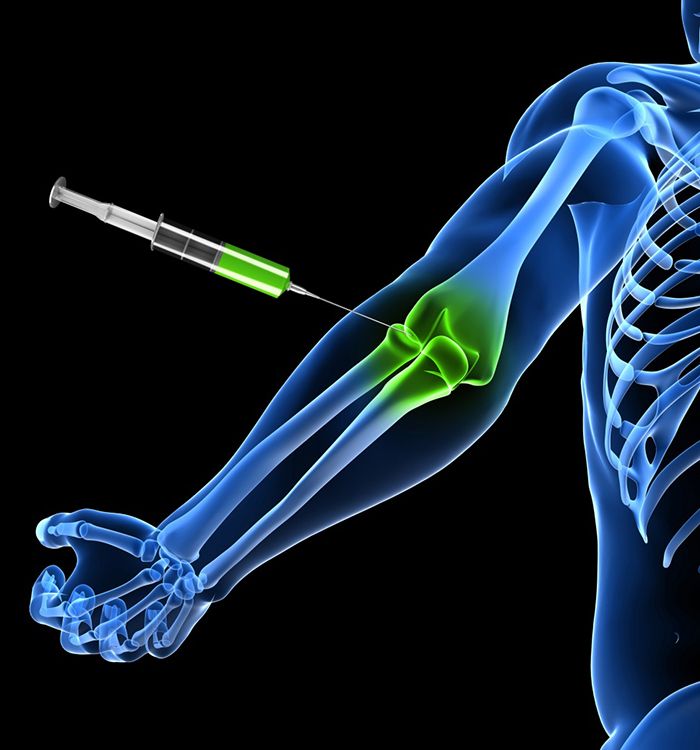 Illustration of injection for patient’s elbow