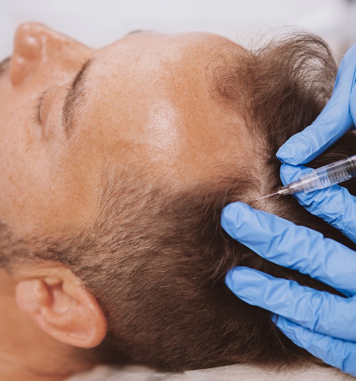 man getting PRP injected into scalp 